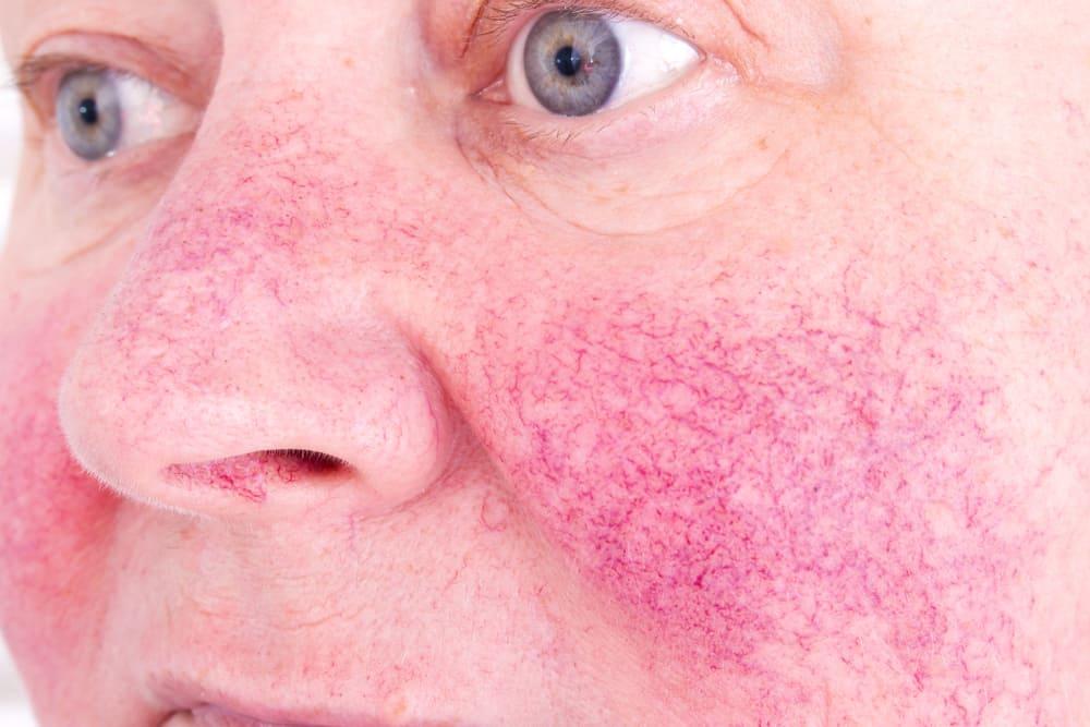 Rosacea (Chứng đỏ mặt)