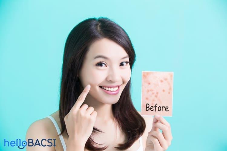 Khánh sinh trị mụn: Nguyên nhân, loại thuốc và cách sử dụng