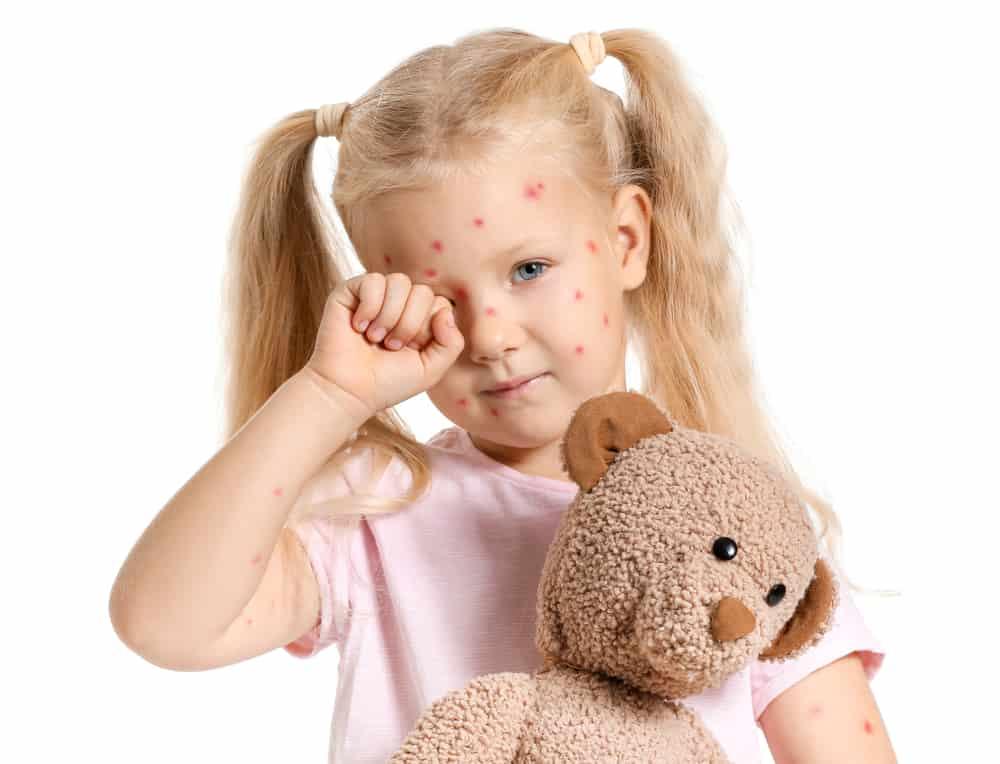 Bệnh thủy đậu (trái rạ)