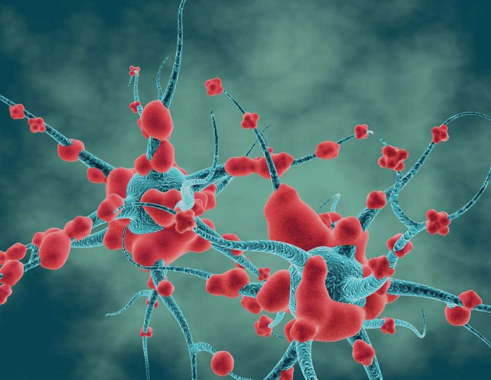 Viêm đa dây thần kinh