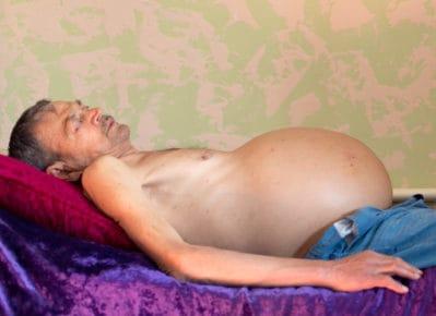 Xơ gan cổ trướng là gì? Triệu chứng, chẩn đoán và điều trị