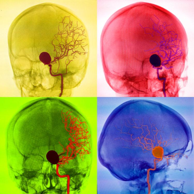 Chụp mạch não đồ