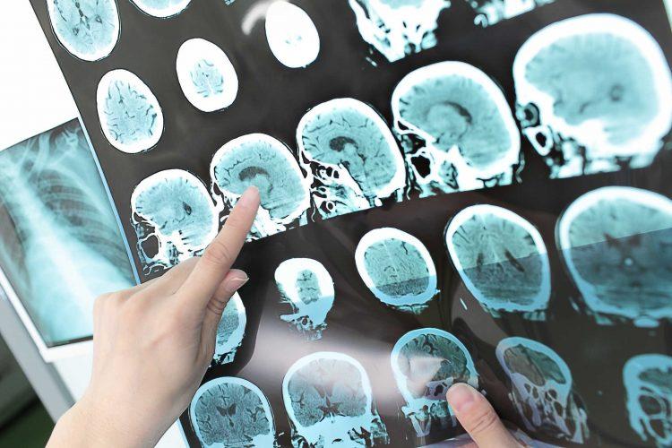 Thoái hóa mạch máu não dạng bột có thể gây đột quỵ xuất huyết