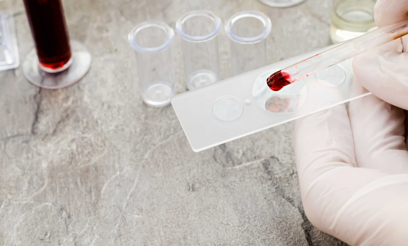 Bệnh mạch máu não có thể gây ra đột quỵ