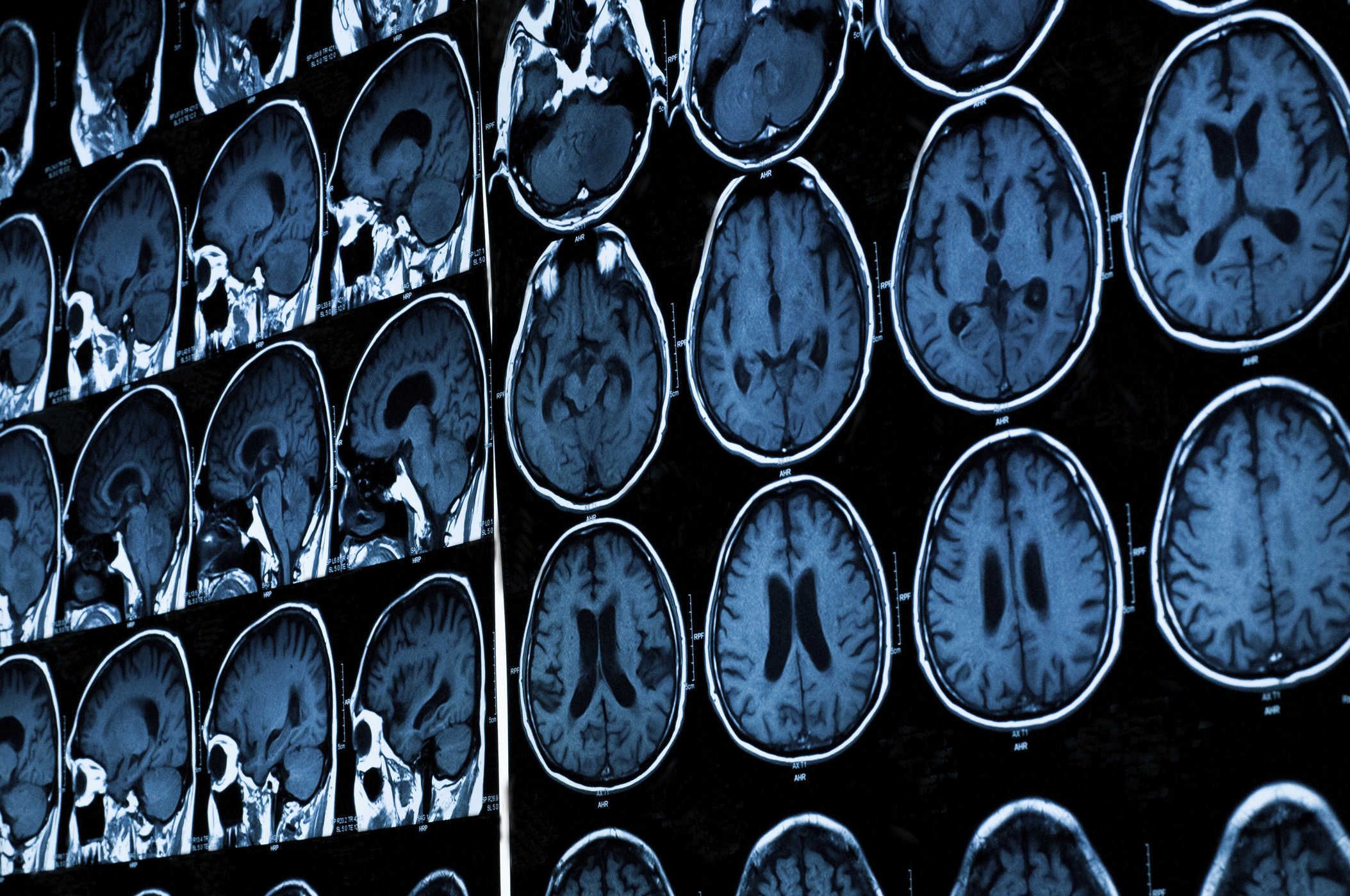5 loại đột quỵ lỗ khuyết