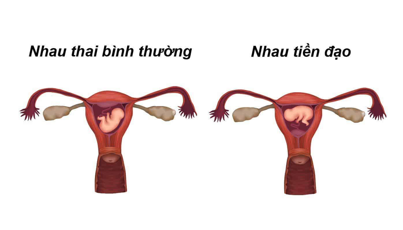 Nhau tiền đạo (rau tiền đạo)