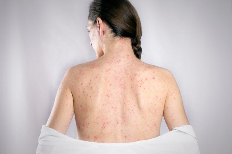 rubella