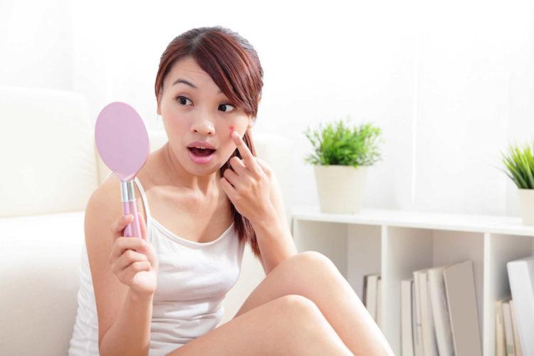 Nguyên nhân gây mụn ở từng vị trí và cách khắc phục
