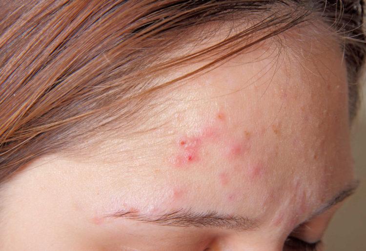 Mụn trứng cá đỏ và những điều bạn cần biết