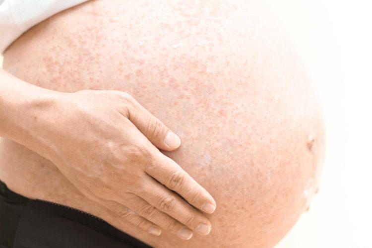 Giảm ngứa cho mẹ bầu mắc bệnh chàm