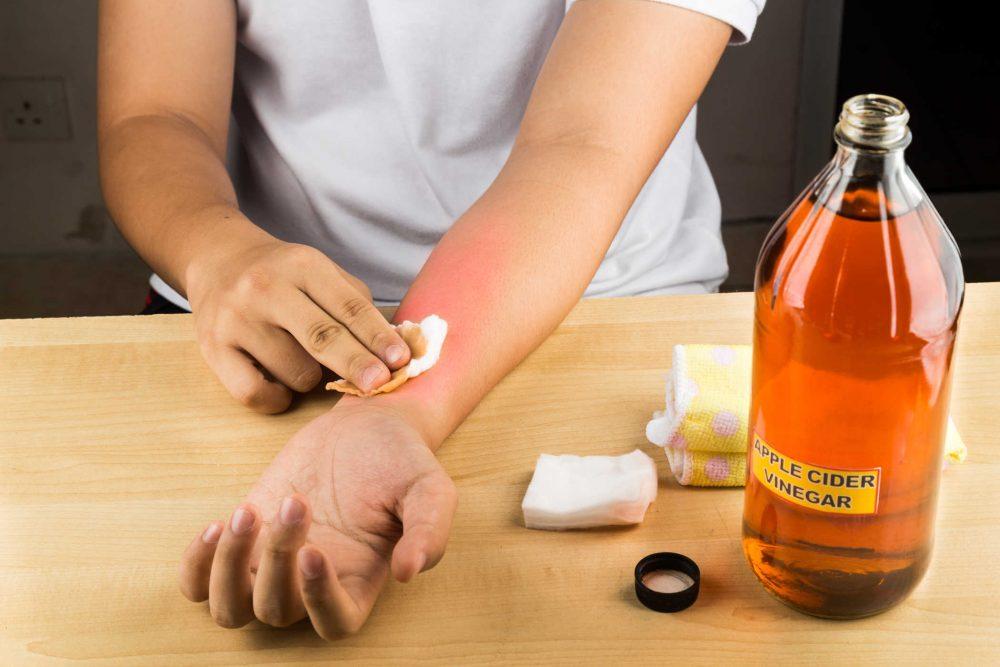 4 bước sơ cứu vết bỏng bởi axit và hóa chất khác