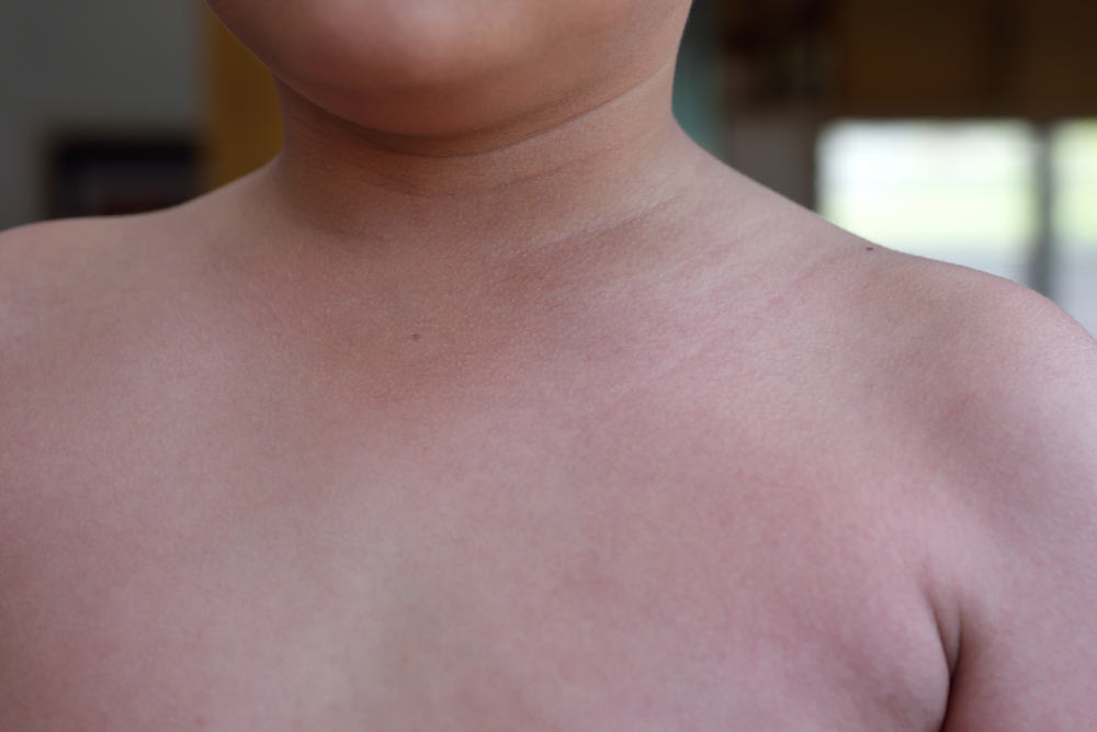 Ban đỏ ở trẻ em (sốt Scarlet)