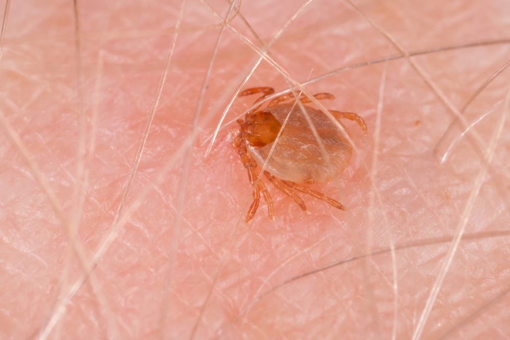 Biên trùng do Anaplasma (bệnh Ehrlichiosis bạch cầu hạt)