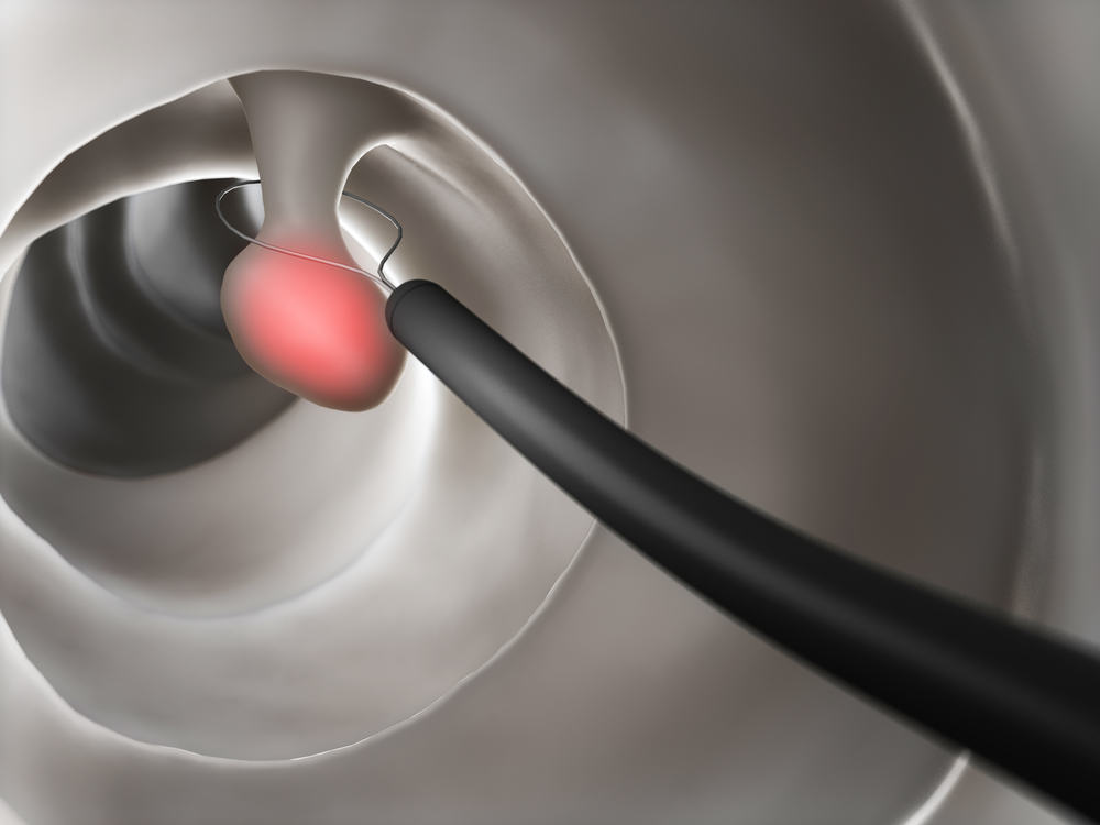 Polyp đại trực tràng