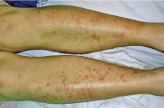 ban-xuat-huyet-henoch-schonlein-hsp