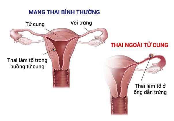 Mang thai ngoài tử cung có dấu hiệu gì? Xử lý và phòng ngừa ra sao?