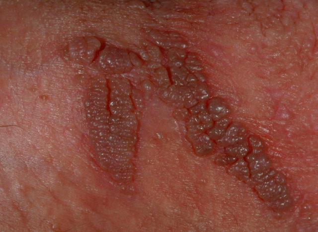 Sùi mào gà: Dấu hiệu, nguyên nhân, chẩn đoán và điều trị