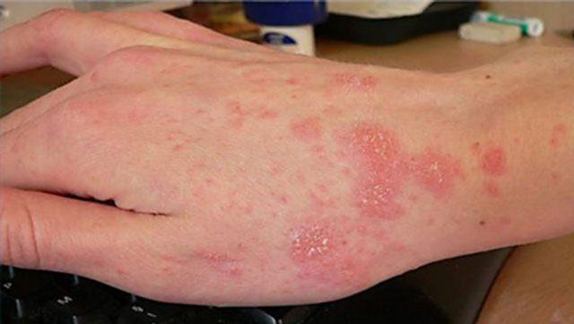 Bệnh ghẻ là gì và làm sao để nhanh khỏi?