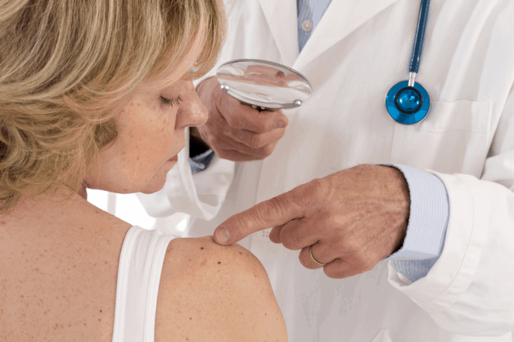 Nốt ruồi và tàn nhang - Những điểm khác biệt