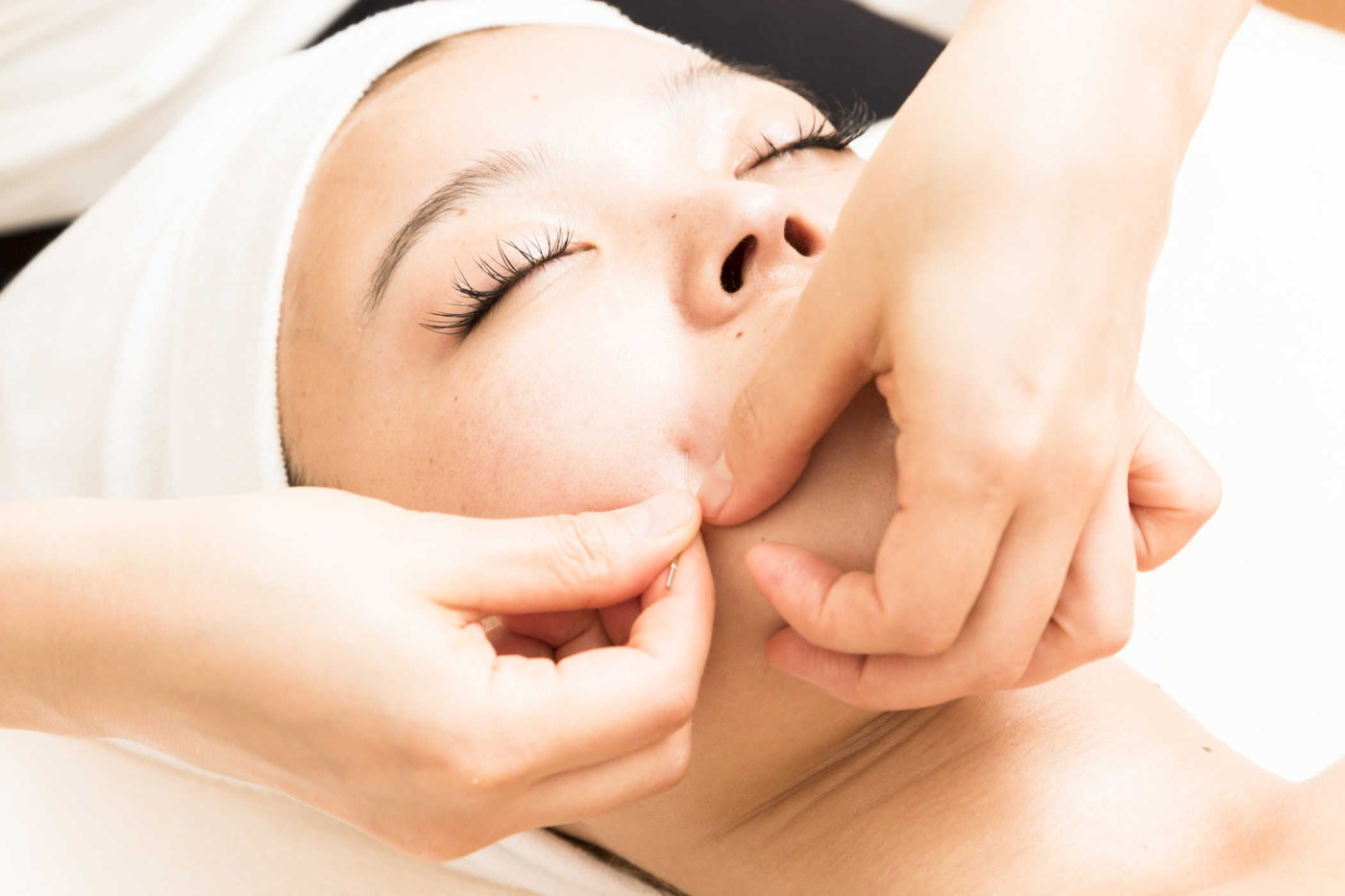 Cải thiện nhan sắc bất ngờ với châm cứu thẩm mỹ