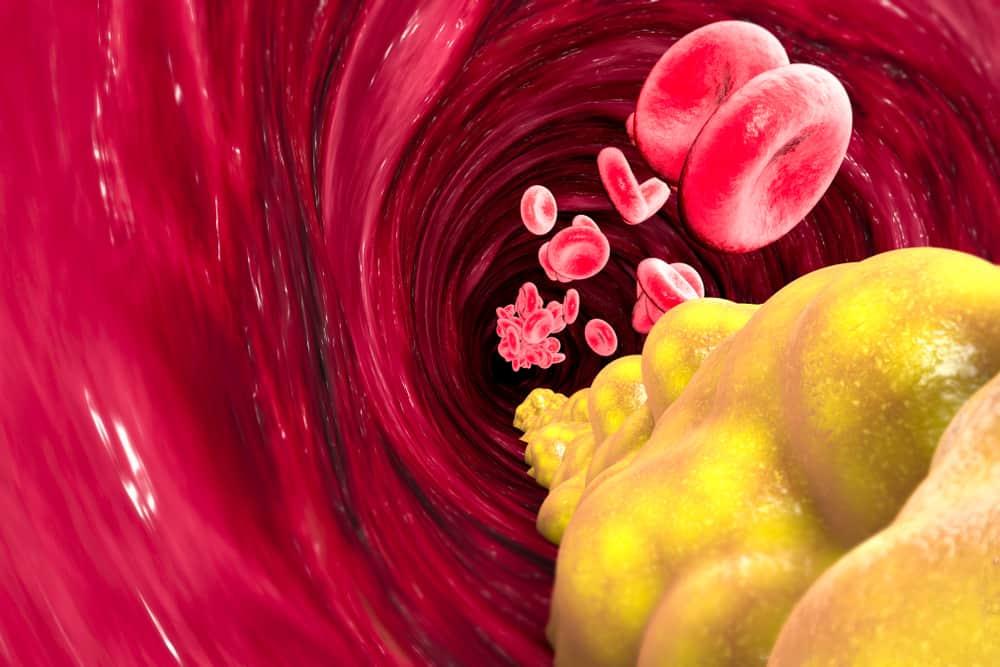 ldl-cholesterol