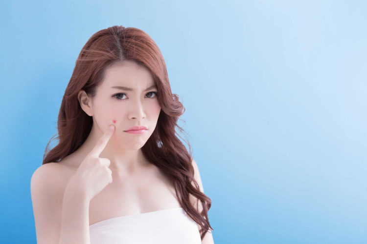 Tất tần tật về điều trị mụn trứng cá bạn cần biết