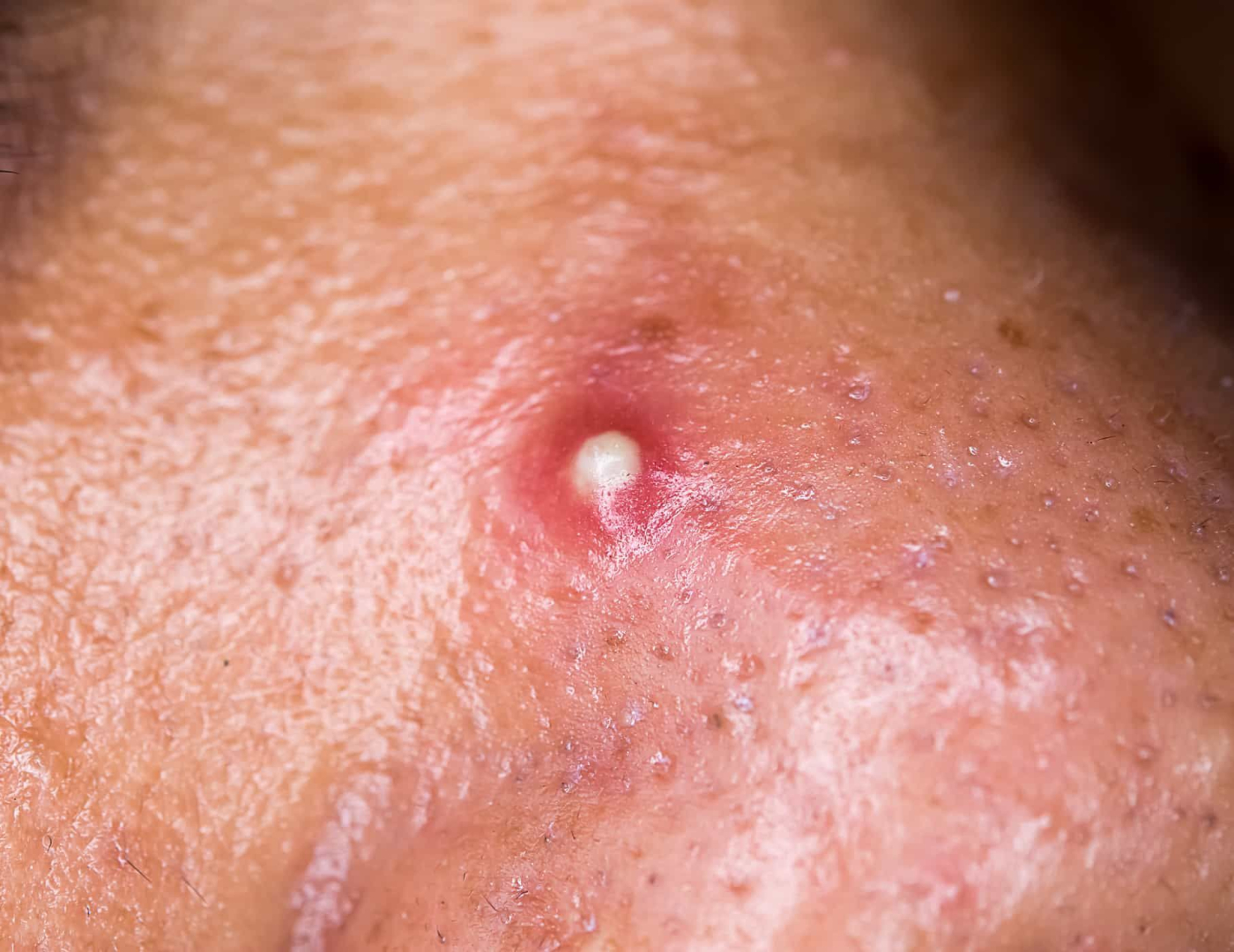 Nhiễm trùng tụ cầu khuẩn