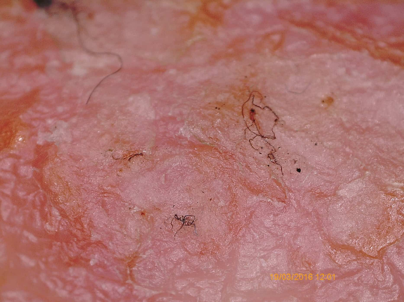 Morgellons