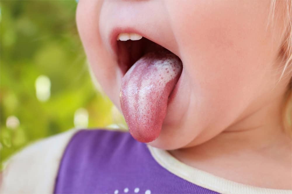 Nhiễm nấm Candida miệng: Nguyên nhân, dấu hiệu, điều trị, phòng ngừa