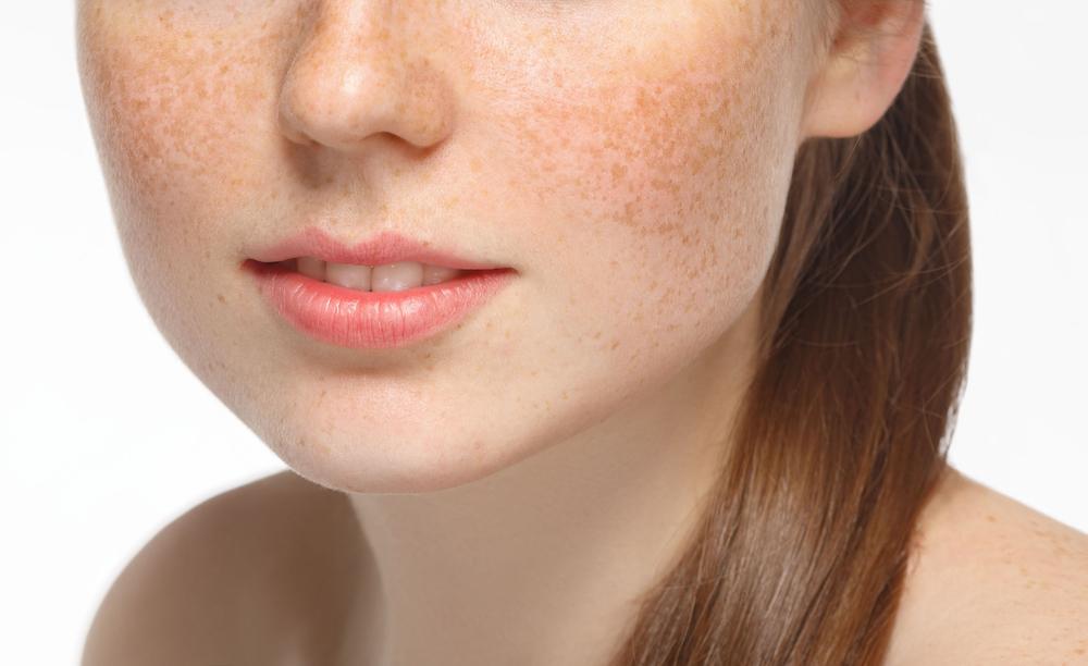 hydroquinone-co-an-toan-de-tri-nam-da