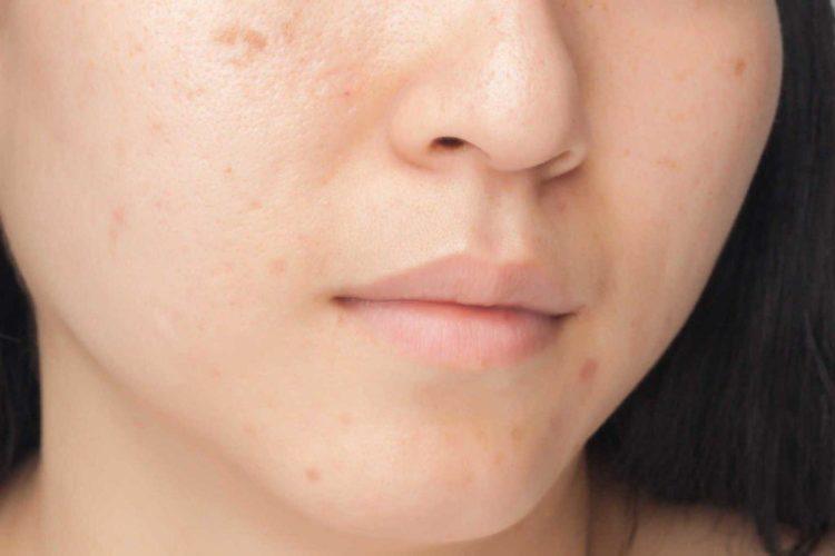 Phân loại và cách trị sẹo mụn hiệu quả