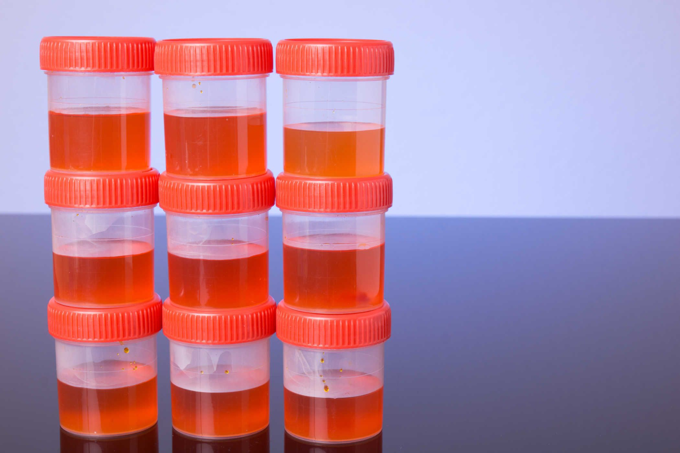 Tình trạng nước tiểu tiết lộ điều gì về sức khỏe của bạn?