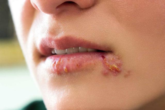 Tất tần tật những thông tin cần biết về bệnh herpes miệng và sinh dục