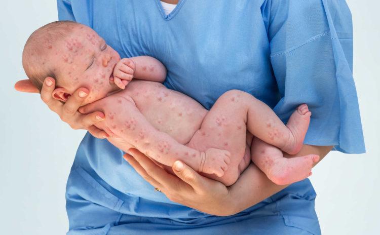 Bệnh ban đào ở trẻ em cần kịp thời theo dõi