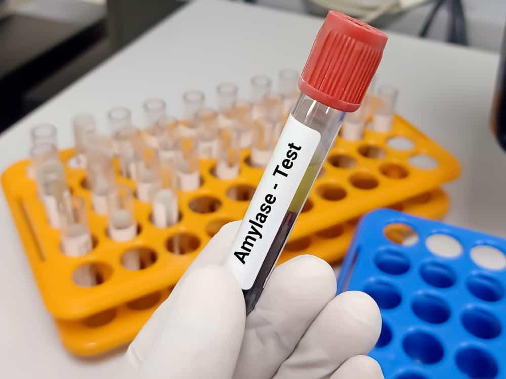 Xét nghiệm amylase: Dùng để chẩn đoán những bệnh lý nào?