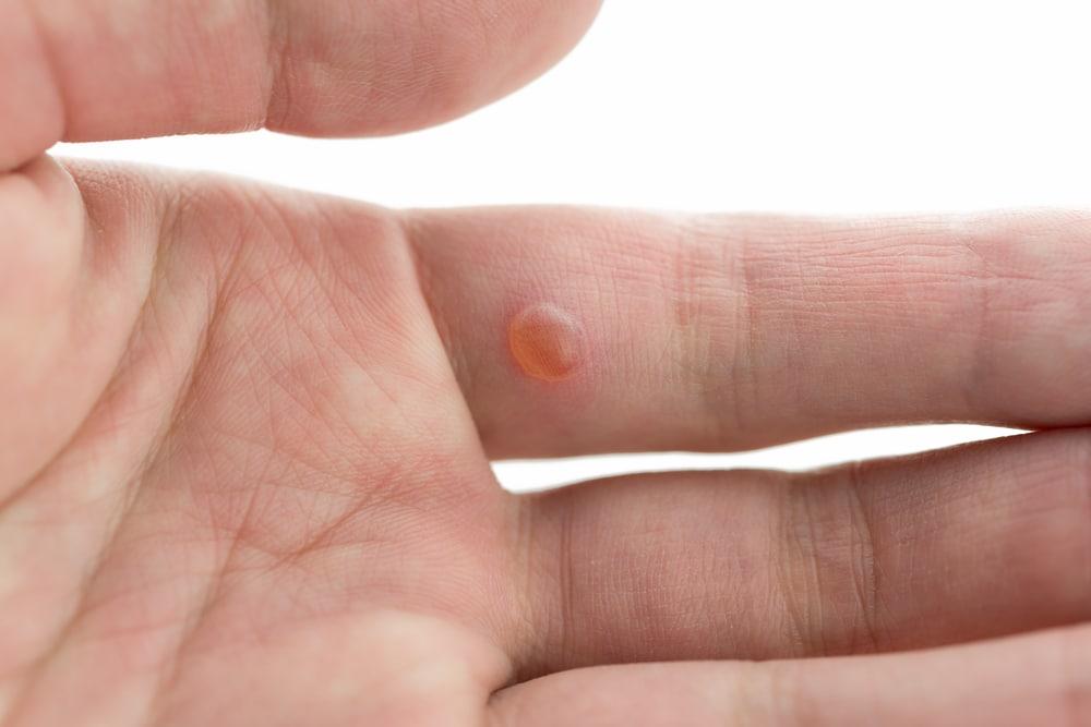 Những điều cần biết về các loại mụn cóc