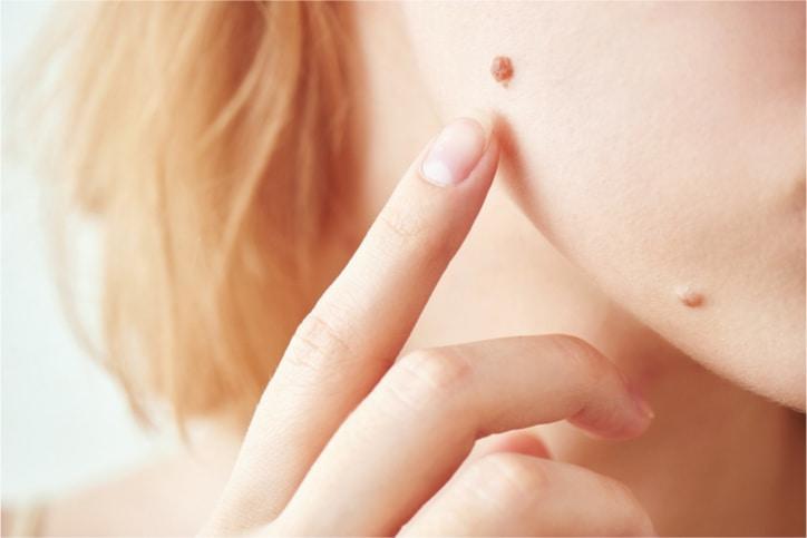 Nốt ruồi báo ung thư: Nhận biết ngay kẻo trễ