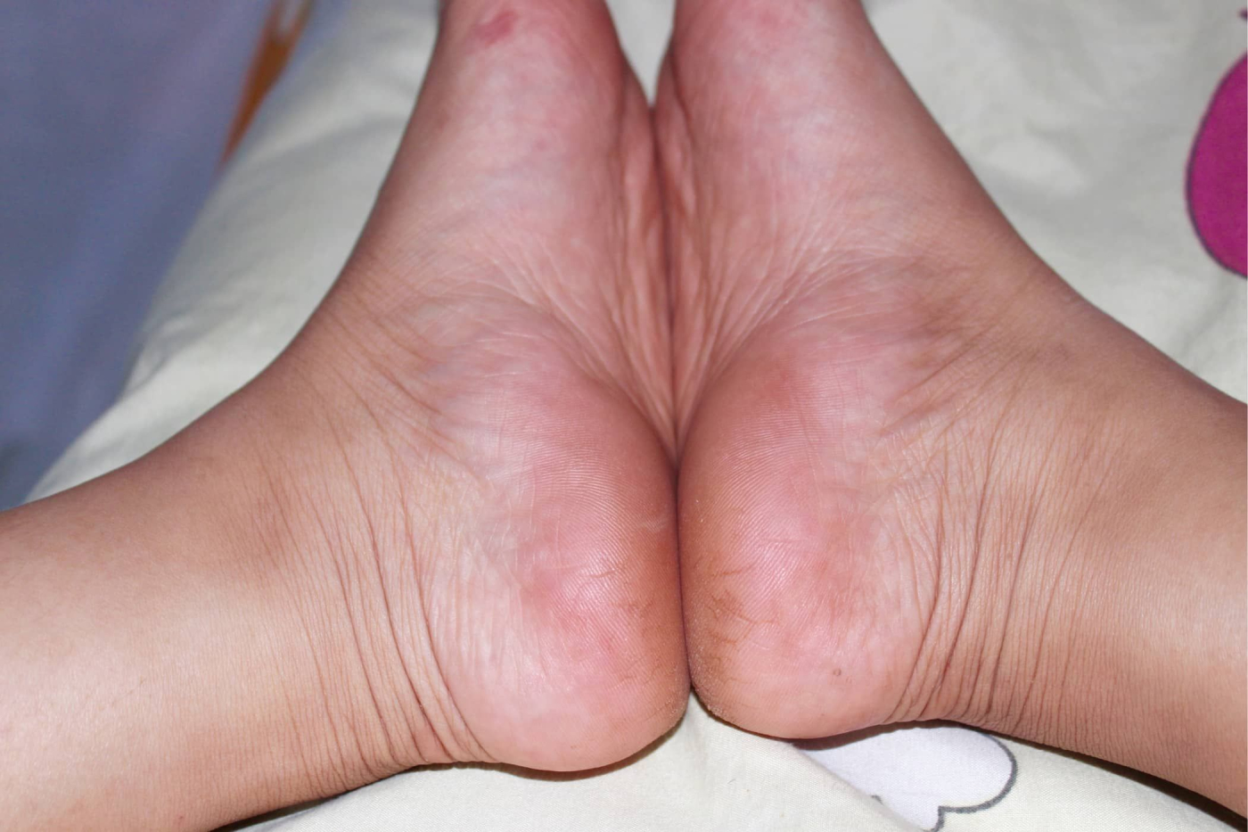 4 cách đơn giản trị nứt nẻ gót chân