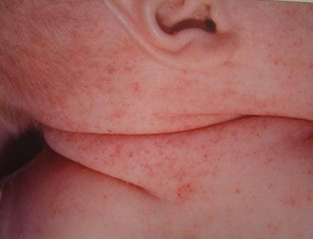 Hội chứng Wiskott–Aldrich