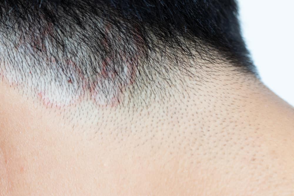 Nấm da đầu: Triệu chứng và cách phòng ngừa