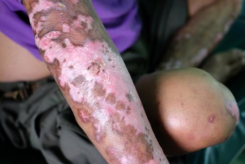 Tolazoline hydrochloride