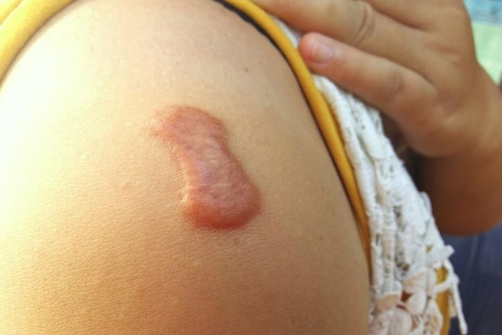 Sẹo lồi và cách ngăn sẹo lồi phát triển