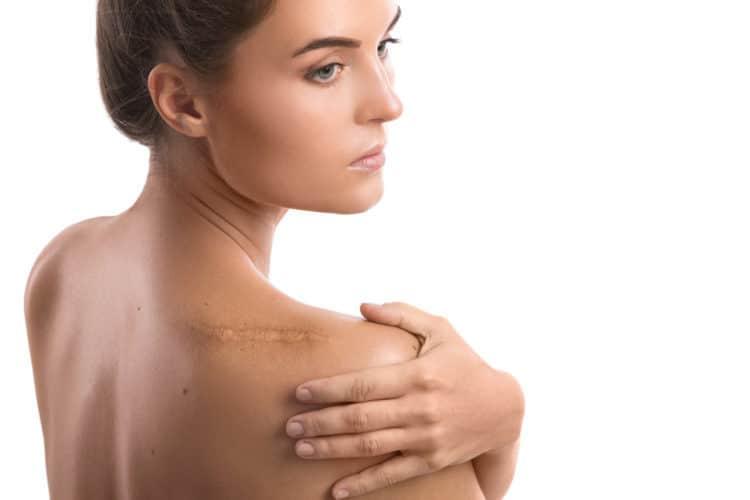 Ngăn ngừa vết sẹo, những điều nên và không nên