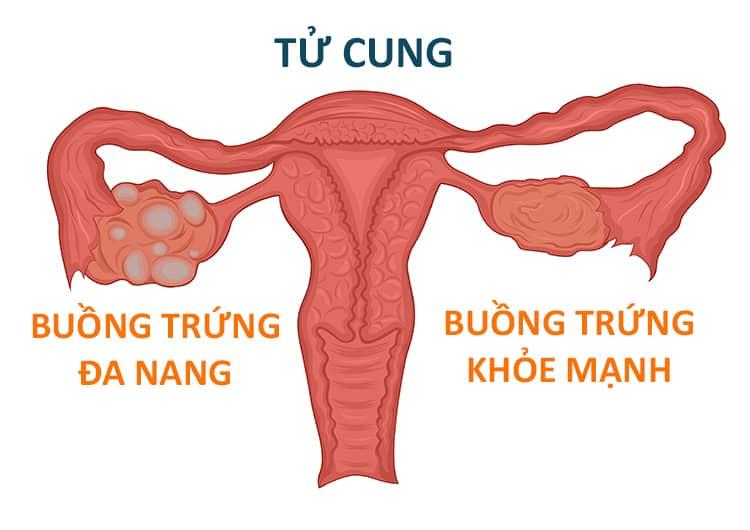 Bị buồng trứng đa nang làm tăng nguy cơ mắc bệnh gì?