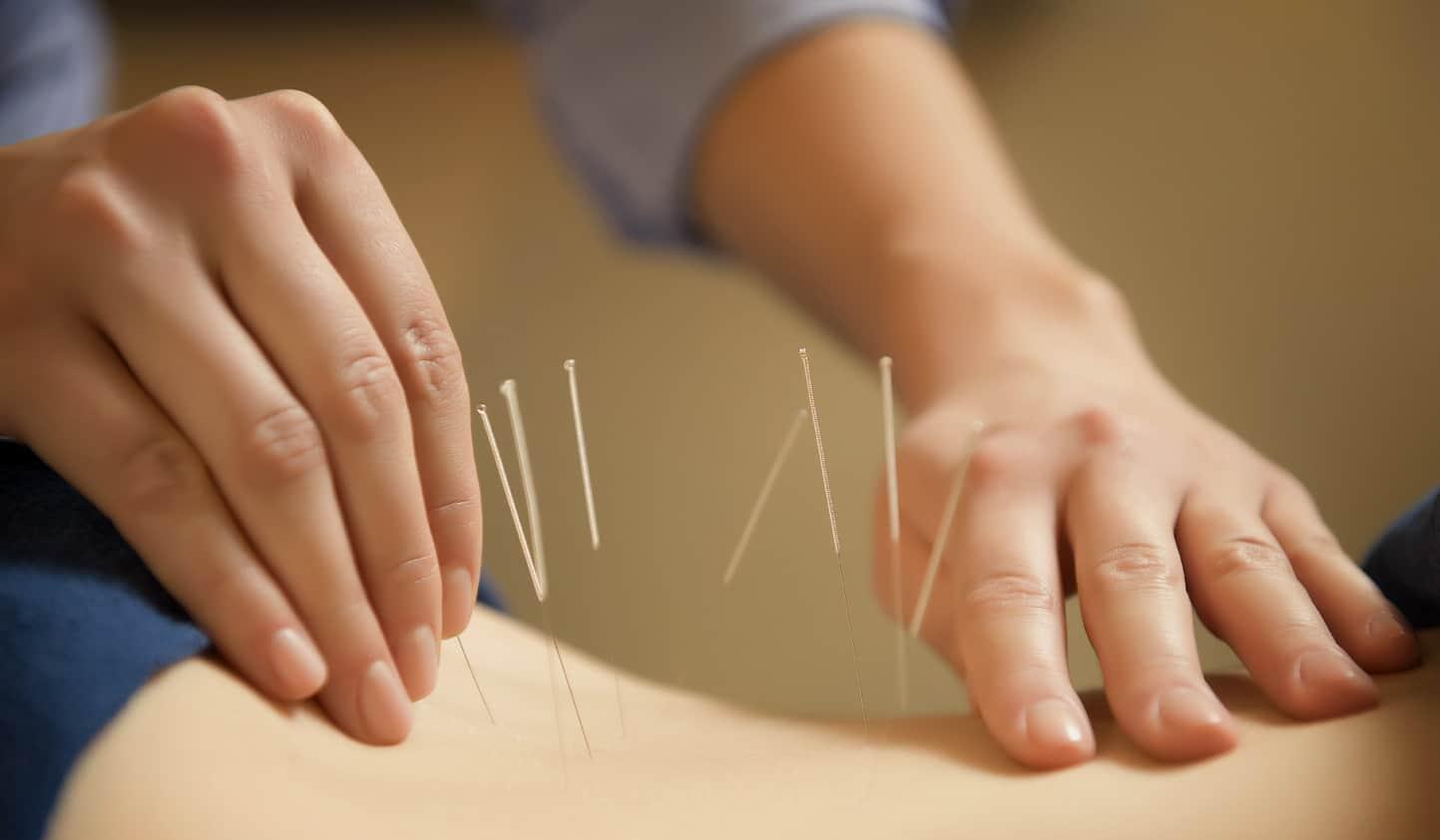 Thực hư về hiệu quả của châm cứu trong điều trị thoái hóa cột sống