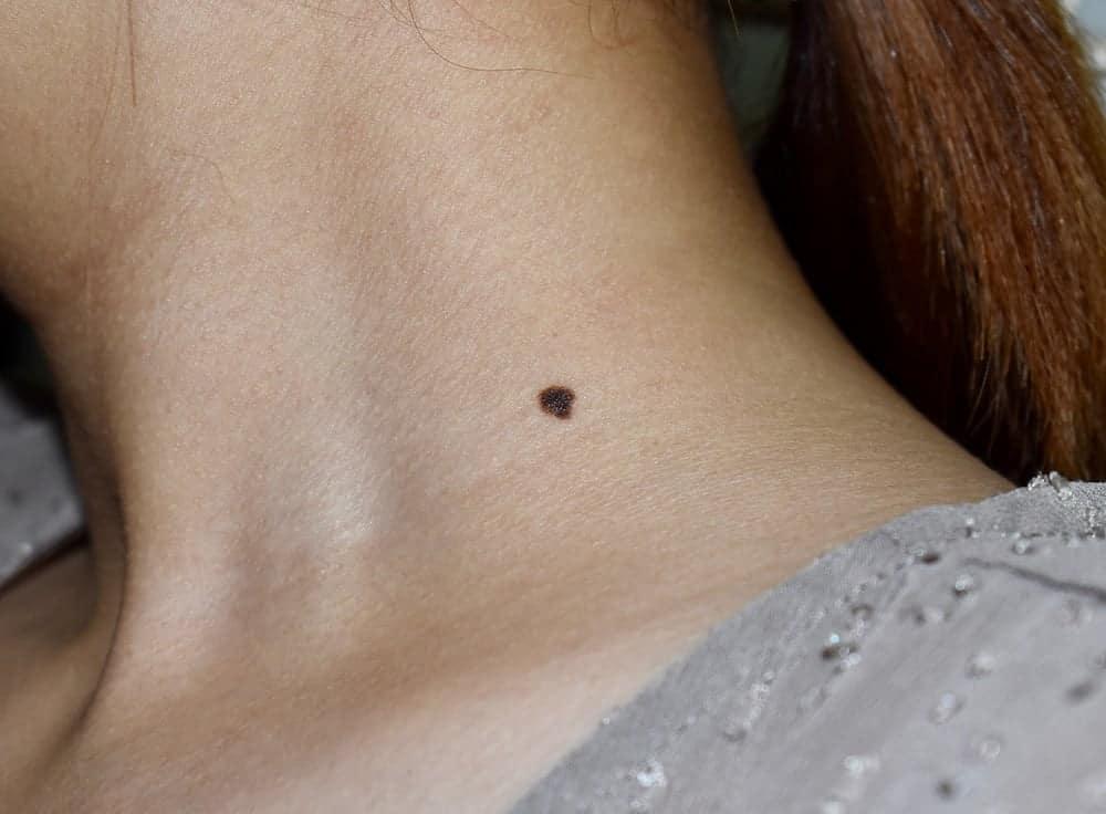 Bạn đã biết gì về xét nghiệm ung thư da?