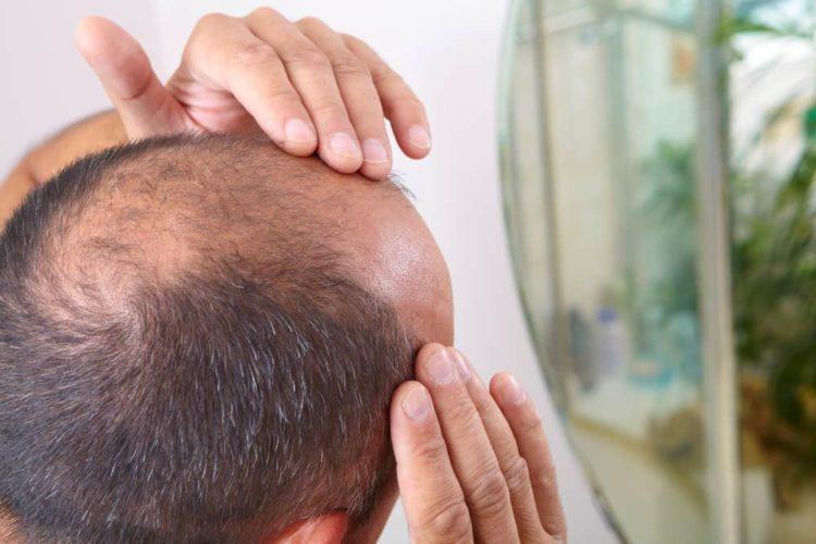 Rụng tóc từng mảng