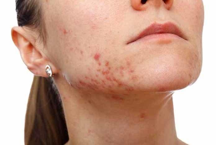 Hội chứng Bloch-Sulzberger