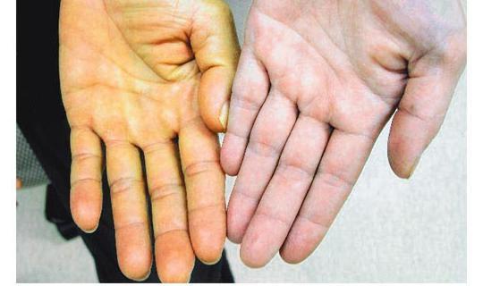 Hội chứng Mirizzi