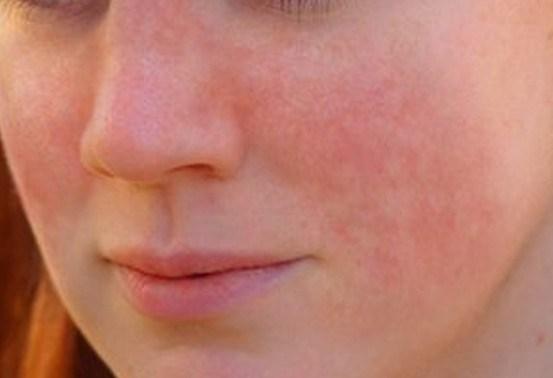 lupus